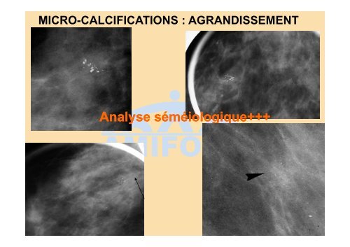 Score BI-RADS de l'ACR et CAT