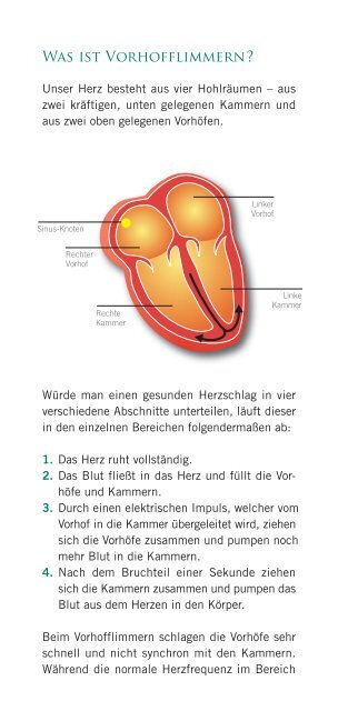 Vorhofflimmern - St. Jude Medical