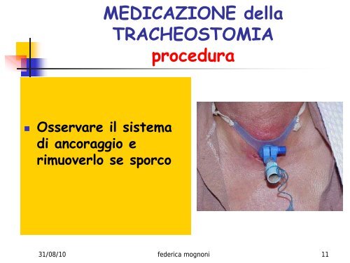 MEDICAZIONE della TRACHEOSTOMIA DEFINIZIONE - Ipasvi