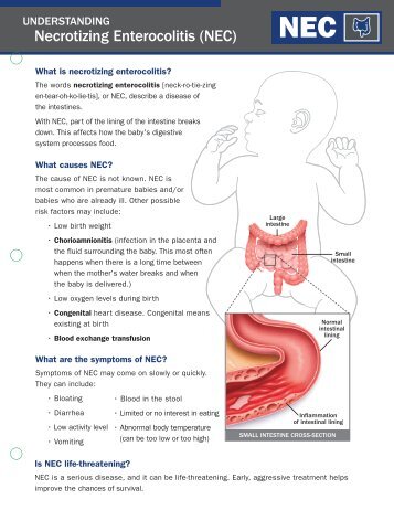 Necrotizing Enterocolitis (NEC) - Associates in Newborn Medicine