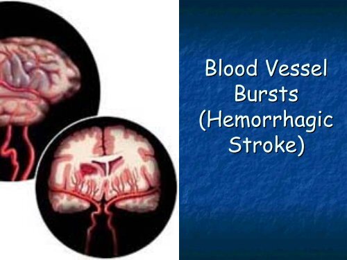 Anatomy Sign Symptoms of Stroke - The Stroke Network of ...