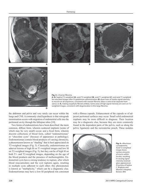 MRI of Benign Female Pelvis