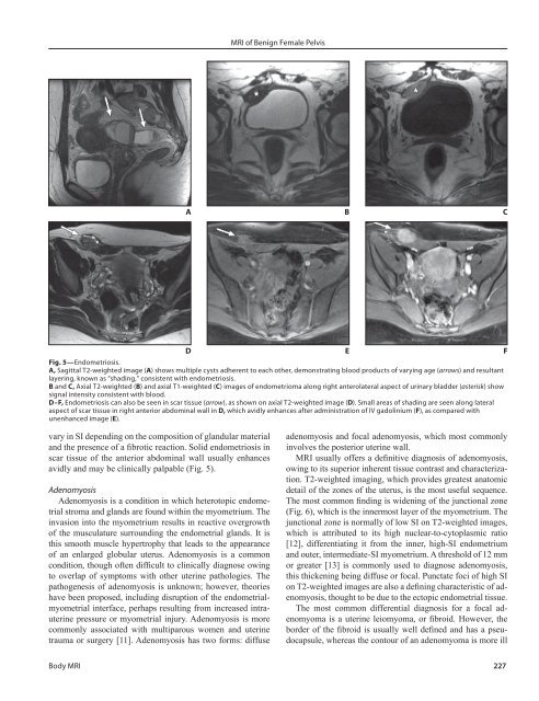 MRI of Benign Female Pelvis