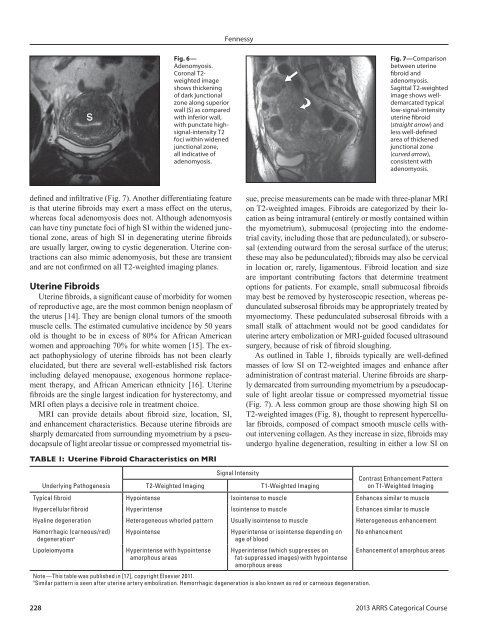 MRI of Benign Female Pelvis