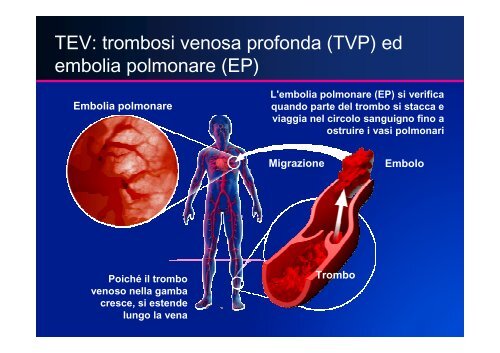 LA PROFILASSI TROMBOEMBOLICA - UniversitÃ  degli Studi del ...