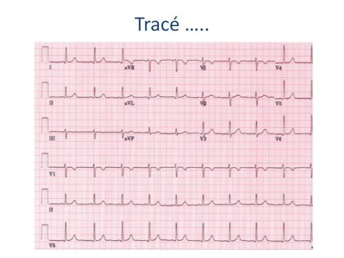 ECGâ¦