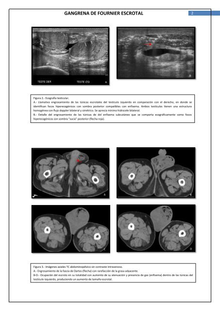 GANGRENA DE FOURNIER ESCROTAL