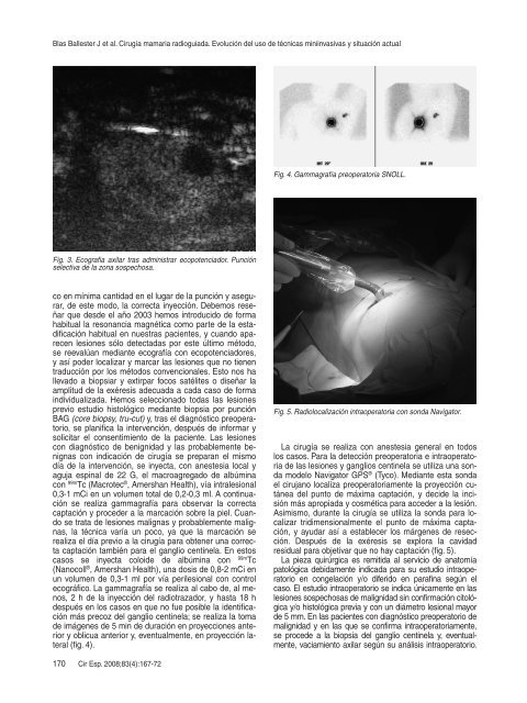 CirugÃ­a mamaria radioguiada. EvoluciÃ³n del uso de tÃ©cnicas ...