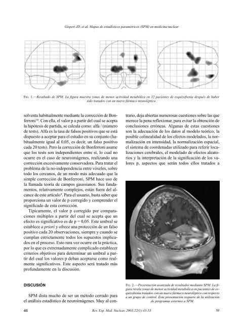 Mapas de estadísticos paramétricos (SPM) en medicina nuclear