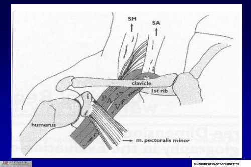 SÍNDROME DE PAGET-SCHROETTER - 30 Congreso de la ...