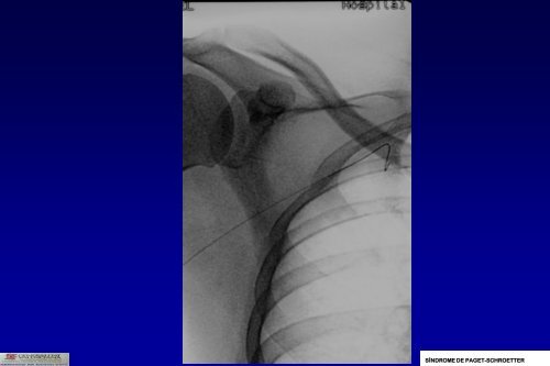 SÍNDROME DE PAGET-SCHROETTER - 30 Congreso de la ...