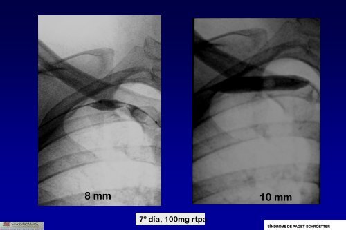 SÍNDROME DE PAGET-SCHROETTER - 30 Congreso de la ...