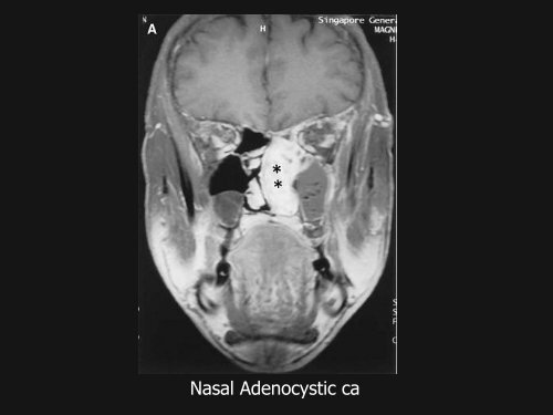 Dr. Tapan Dhibar Oncoradiology Of Head And Neck - Aroi.org