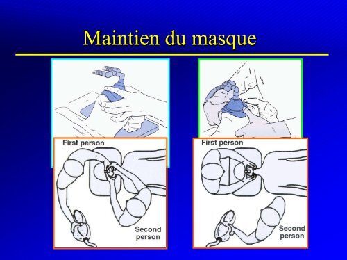 CONTRÃLE DES VOIES AERIENNES - INTUBATIONS DIFFICILES