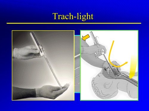 CONTRÃLE DES VOIES AERIENNES - INTUBATIONS DIFFICILES