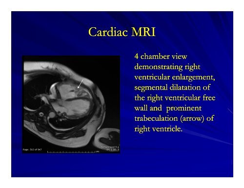 Arrhythmogenic Right Ventricular Dysplasia/Cardiomyopathy