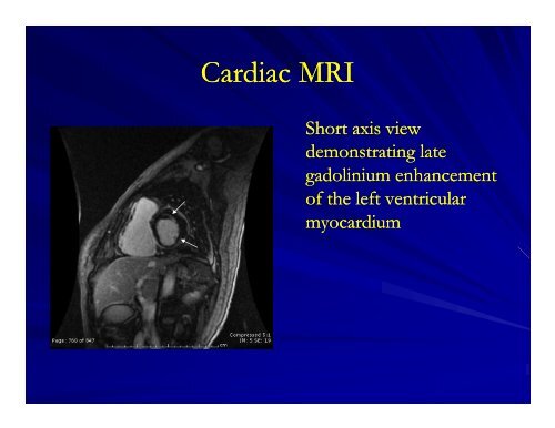 Arrhythmogenic Right Ventricular Dysplasia/Cardiomyopathy