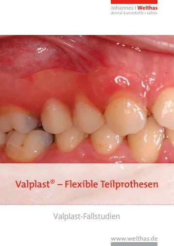 Valplast® – Flexible Teilprothesen - Reif Zahntechnik