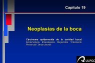 Neoplasias de la boca