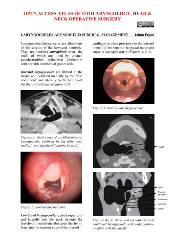 Laryngocoele, laryngocele - Vula - University of Cape Town