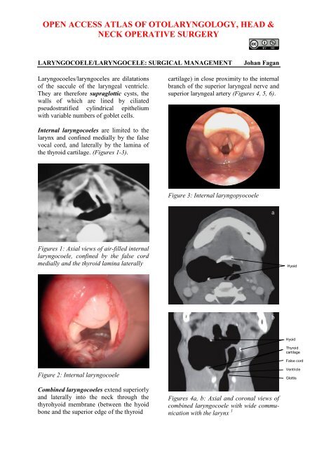 Laryngocoele, laryngocele - Vula - University of Cape Town