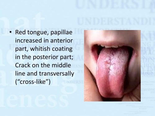 Pulsatilla: tonsillitis - Dr. Gheorghe Jurj - Homeopatie