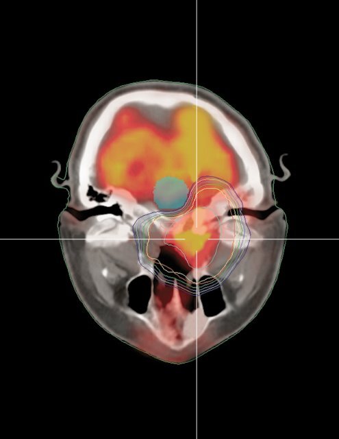 Stereotactic Radiation Therapy: Expanding Capabilities - Varian