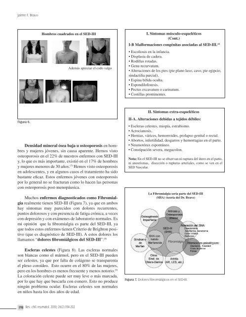 SÃ­ndrome de Ehlers-Danlos tipo III, llamado tambiÃ©n SÃ­ndrome de ...