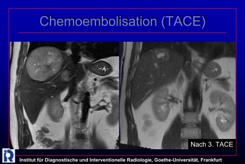 Institut fÃ¼r Diagnostische und Interventionelle Radiologie, Goethe ...