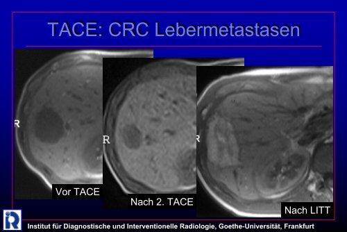 Institut fÃ¼r Diagnostische und Interventionelle Radiologie, Goethe ...