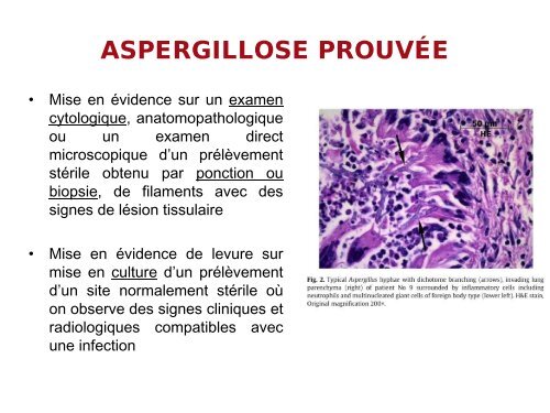 Aspergillose invasive : épidémiologie, diagnostic et traitement.