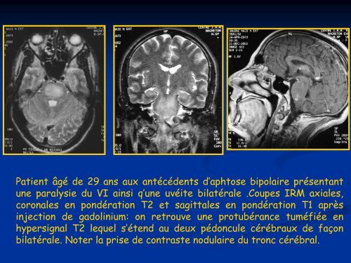 ASPECT IRM DU NEUROBEHCET. A PROPOS DE 34 CAS