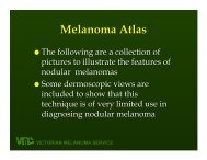 VICTORIAN MELANOMA SERVICE Nodular Melanoma