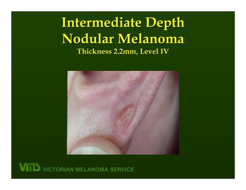 VICTORIAN MELANOMA SERVICE Nodular Melanoma