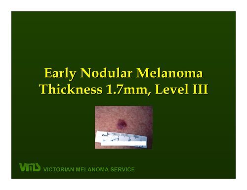 VICTORIAN MELANOMA SERVICE Nodular Melanoma