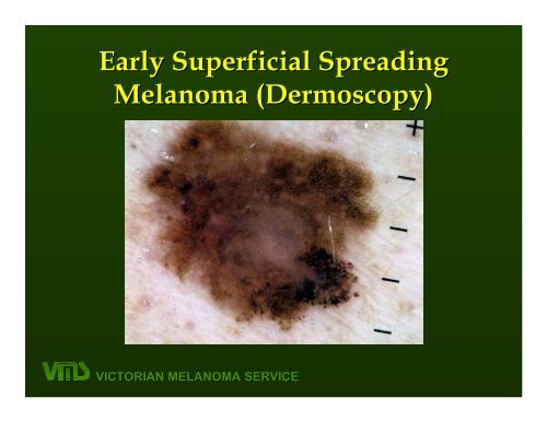 VICTORIAN MELANOMA SERVICE Nodular Melanoma