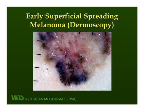 VICTORIAN MELANOMA SERVICE Nodular Melanoma