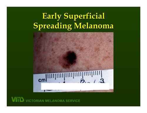 VICTORIAN MELANOMA SERVICE Nodular Melanoma