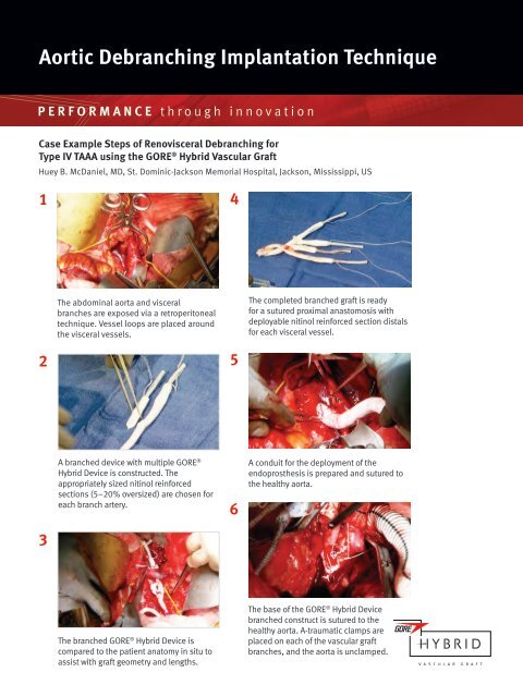 Debranching Technique Implantation Steps - Gore Medical