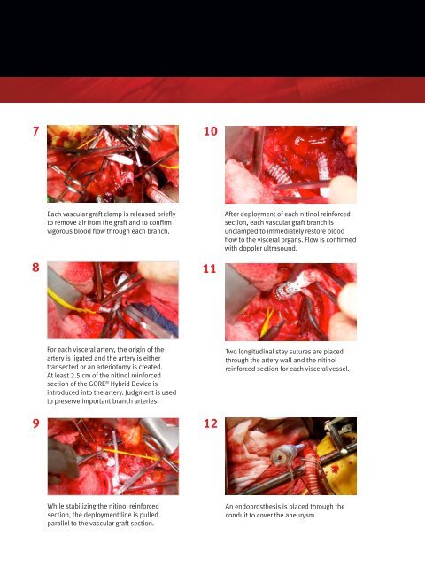 Debranching Technique Implantation Steps - Gore Medical