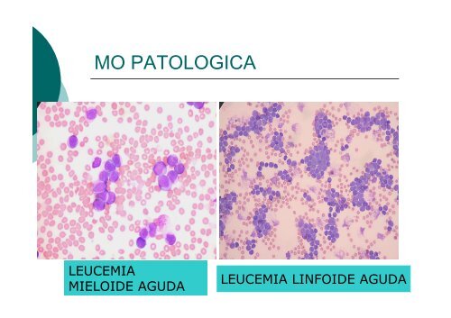 1.- Leucemias Agudas I.pdf