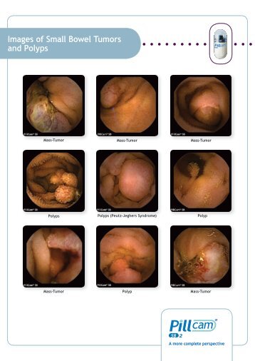 Images of Celiac Disease - Diagmed