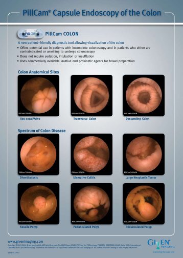 PillCam® Capsule Endoscopy of the Colon - Inclino