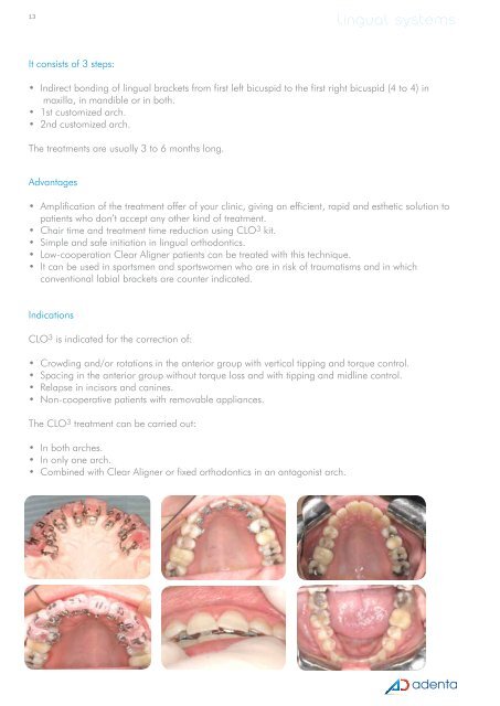 EVOLUTION SLT™ | JOY™ LINGUAL - Adenta