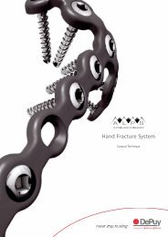 (ALPS) Hand Fracture System Surgical Technique - Biomet