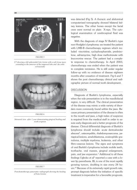 African Type Burkitt's Lymphoma - dishekdergi.hacettepe.edu.tr