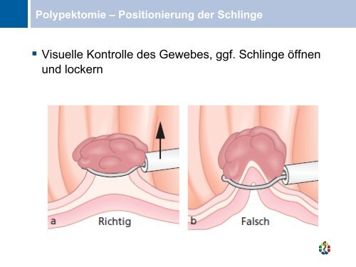 Polypektomie und Blutung, Gerner, Endoskopieseminar 2012