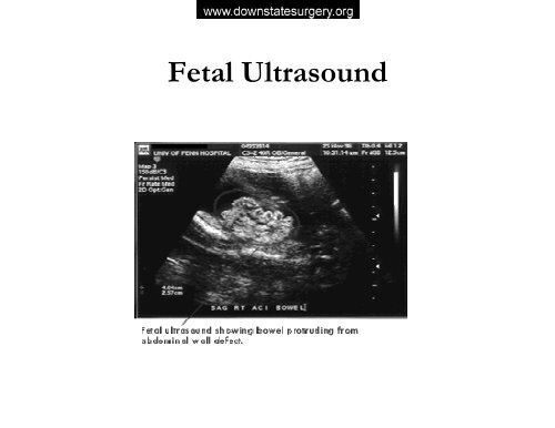 Abdominal Wall Defects - Department of Surgery at SUNY ...