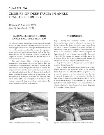 closure of deep fascia in ankle fracture surgery - The Podiatry Institute