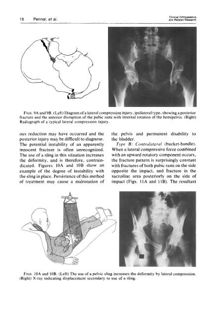 Pelvic Disruption: Assessment and Classification